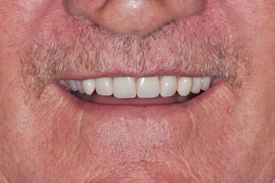 smile in a day - after